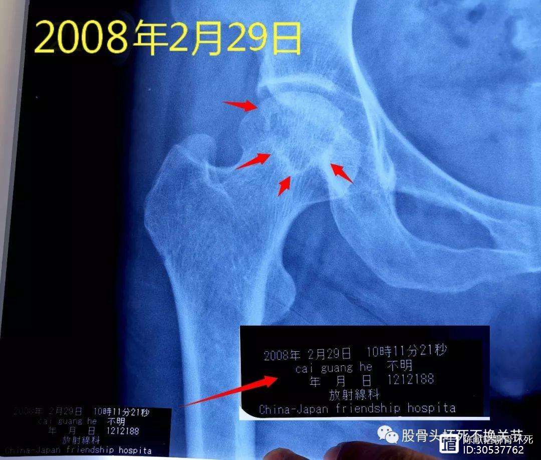 九江人工骨头医保报销多少(人工骨头医保报销多少比例)